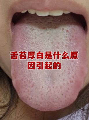 舌苔白厚腻是什么原因造成的